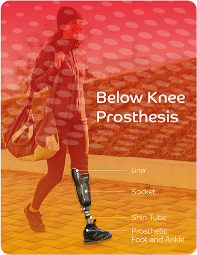 Bk Prosthesis Diagram (003) (1)